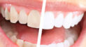 Private: Teeth Whitening Trends