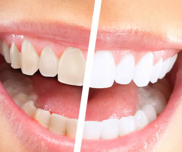 Private: Teeth Whitening Trends